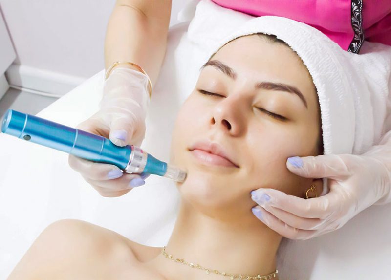 microneedling facial